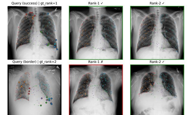 Chest X-ray retrieval explanations from Graph-of-Differences: two query radiographs beside their top retrievals, overlaid with coloured anatomy-graph nodes on the lung and heart regions.