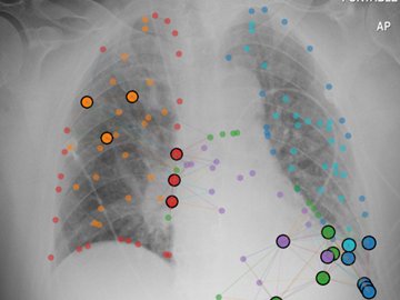 Chest X-ray with Graph-of-Differences anatomy-graph nodes over the lung and heart regions