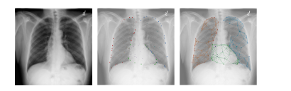 CXR anatomy graph construction for Graph-of-Differences