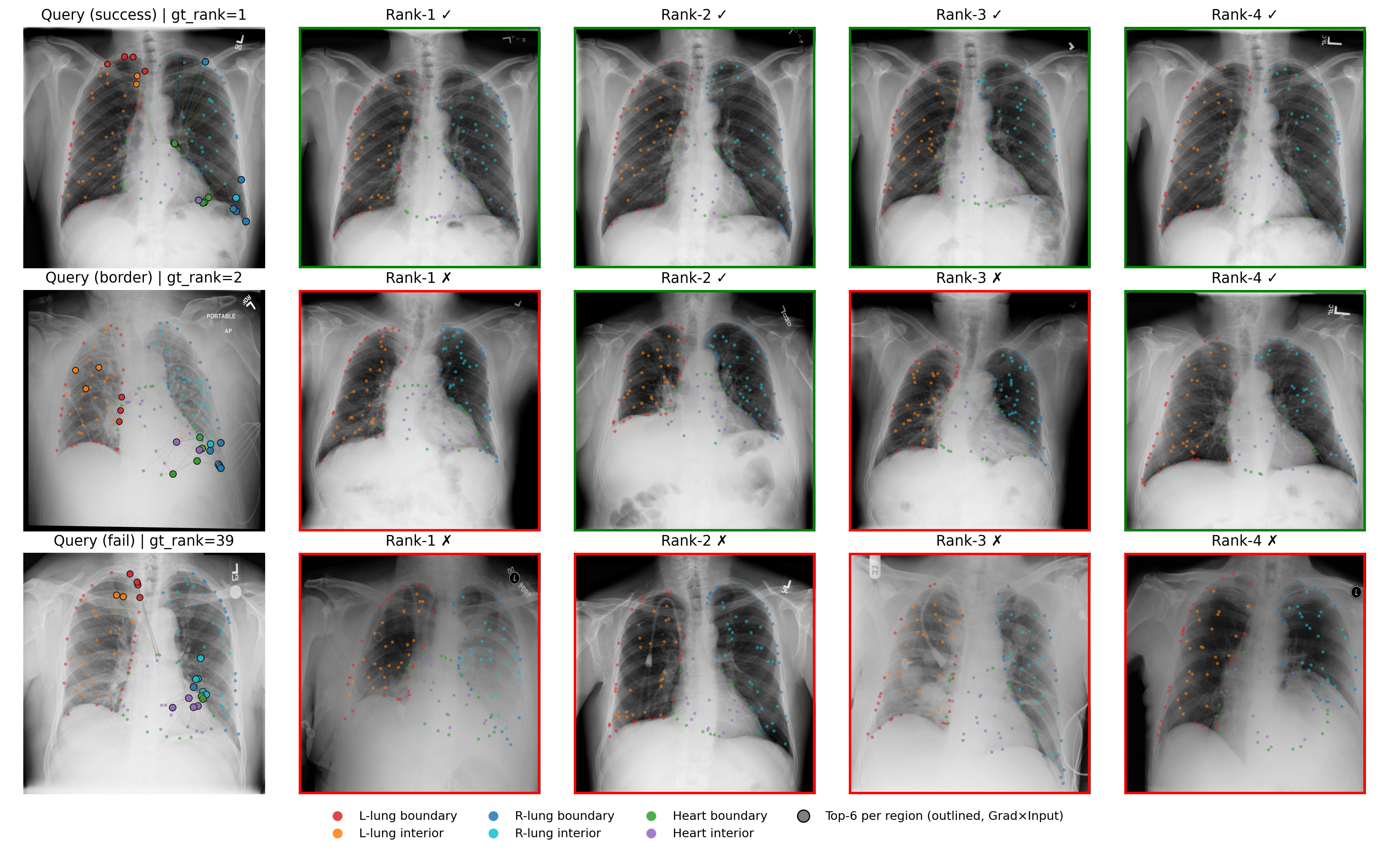 CXR anatomy-aware retrieval explanations